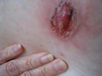 skin pics sept 30 2008 106 stomach lesion